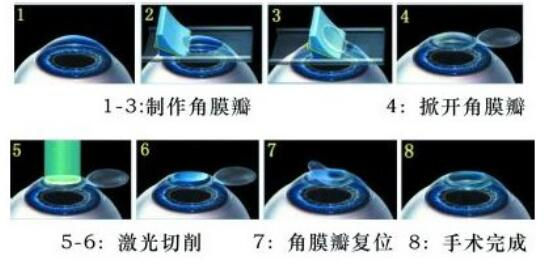 準(zhǔn)分子激光手術(shù)到底是怎么治 愈你的眼睛的？