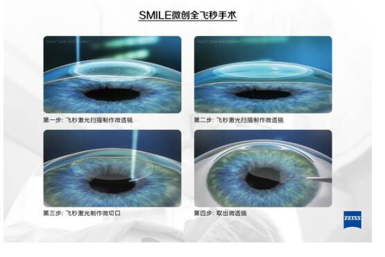準(zhǔn)分子激光手術(shù)到底是怎么治 愈你的眼睛的？