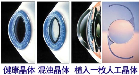 超聲乳化手術(shù)白內(nèi)障危險(xiǎn)嗎？