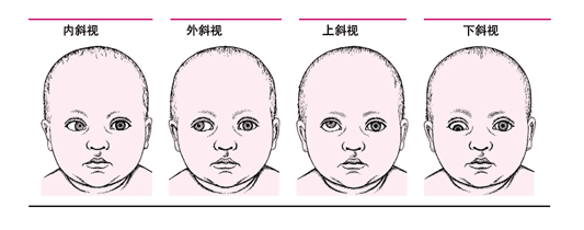 發(fā)現孩子是斜眼怎么好