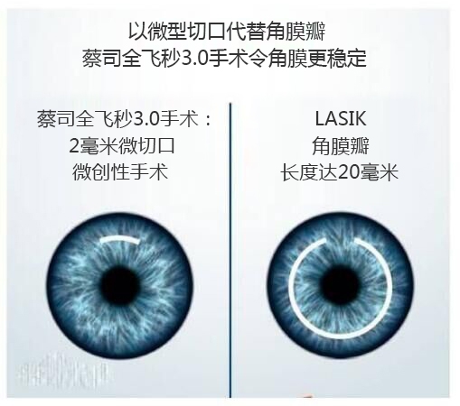 做完近視手術(shù)要休息多長時間？需要住院嗎？