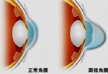 圓錐角膜，哪種角膜移植術(shù)好？