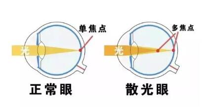 近視和散光，手術(shù)能同時(shí)矯正嗎？