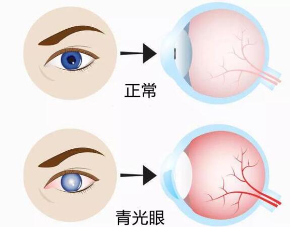 第17個(gè)青光眼周｜共管慢病青光眼，留得光明恒久遠(yuǎn)